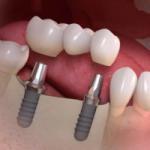 multiple implants ealing london - sss clinic