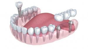 Multiple Implants ealing, London