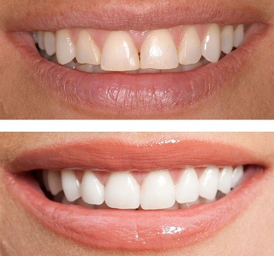 Porcelain Veneers ealing london