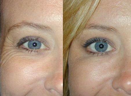 wrinkle treatment ealing