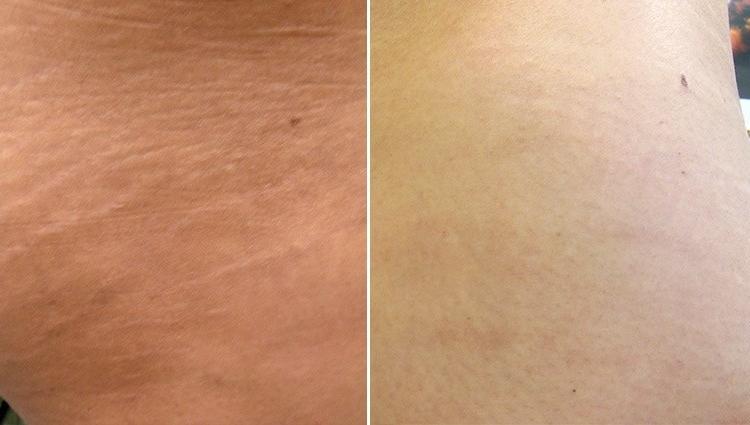 Stretch Marks Removal Treatment Ealing